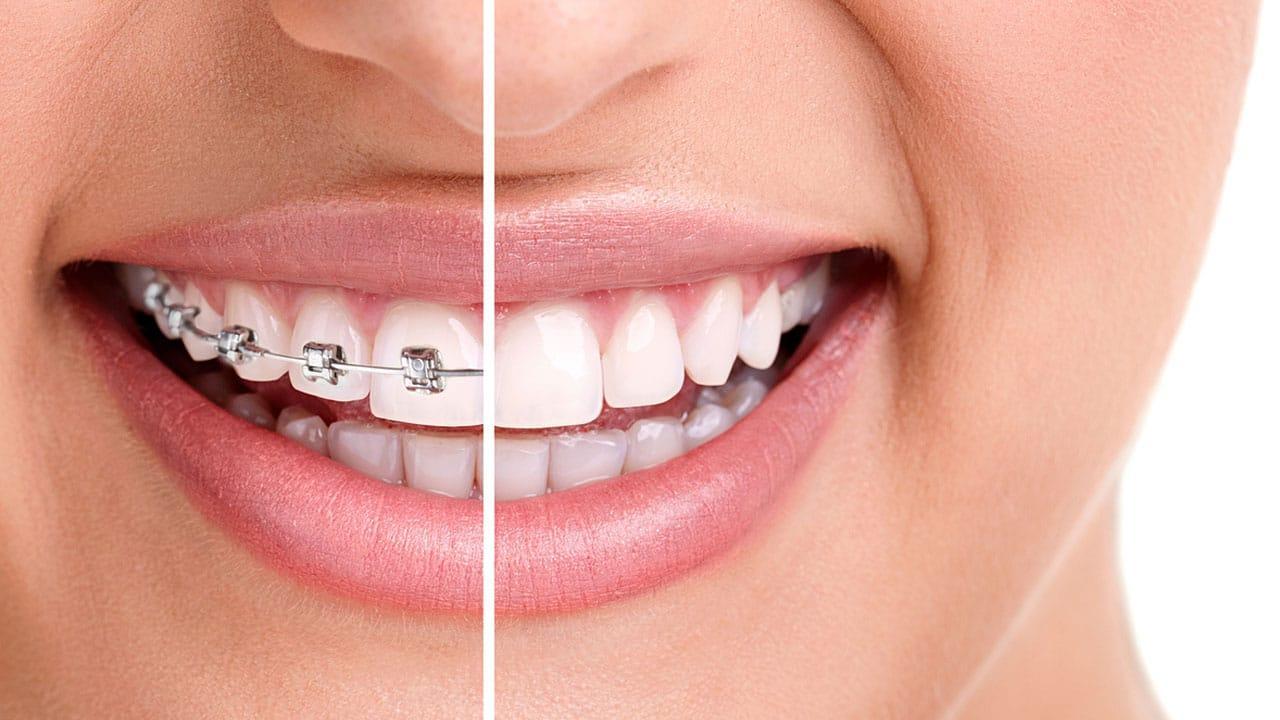 Orthodontic-Braces-Treatment