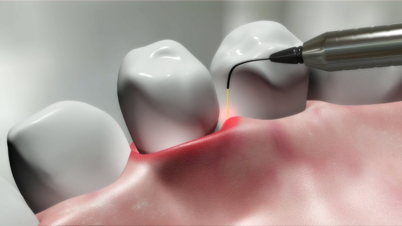 laser-dentist-dental-clinic-gum-ahmedabad-pankti-patel-gujarat-india