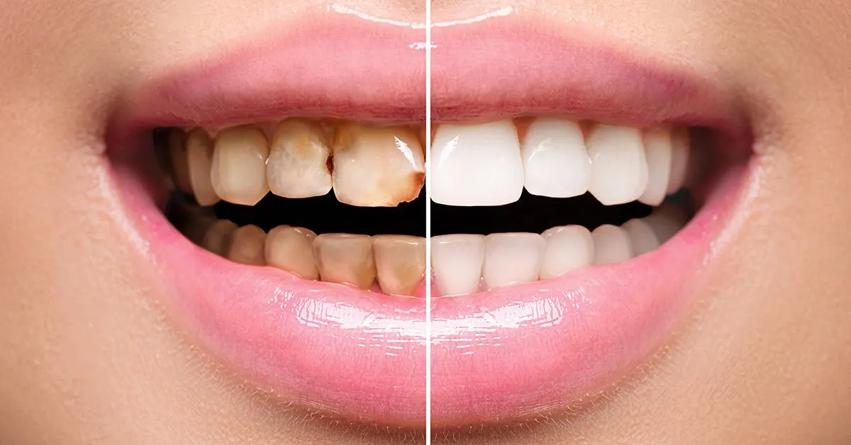 teeth-before-and-after-1920w
